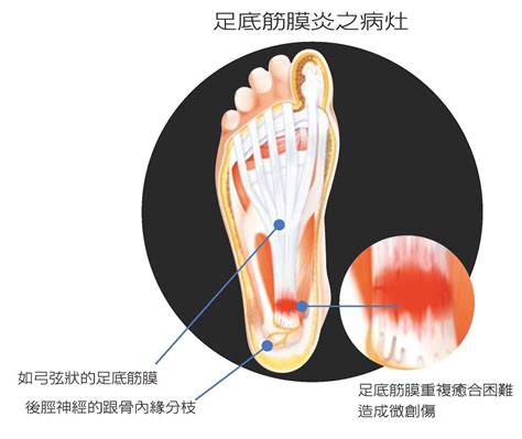 吱腳板底|腳板底痛不一定是足底筋膜炎!